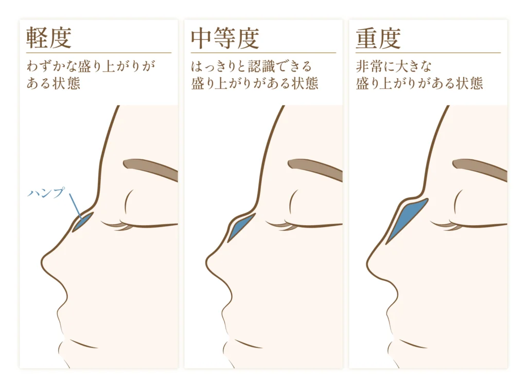 鷲鼻の重症度別の図解画像