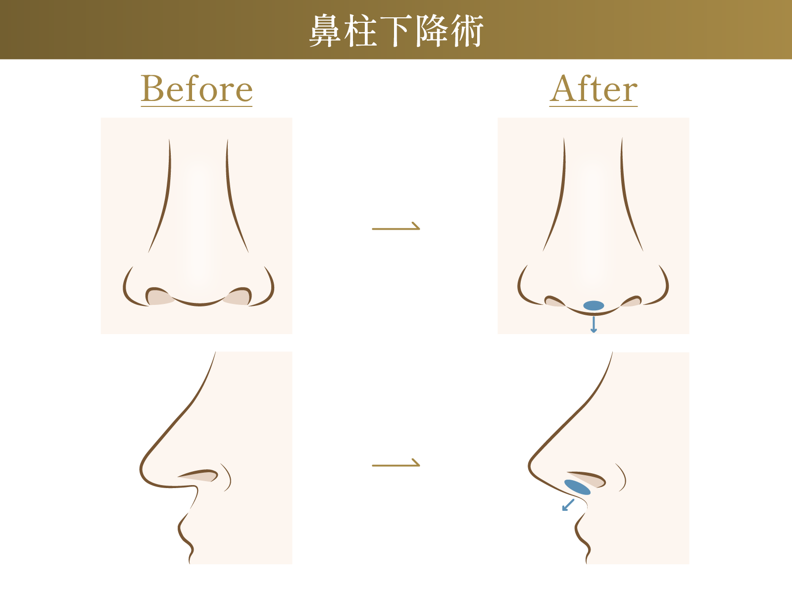 鼻柱下降についての図解画像