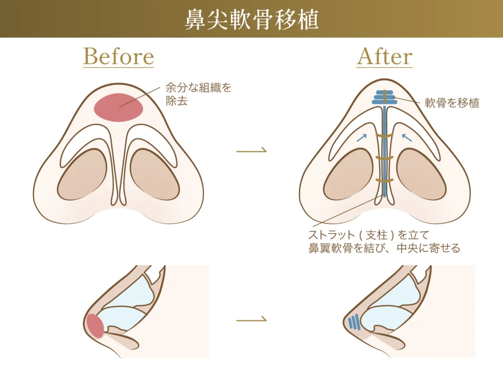 鼻尖軟骨移植による変化についての説明画像