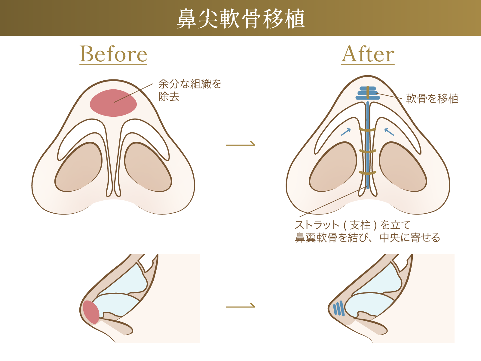 鼻尖軟骨移植による変化についての説明画像