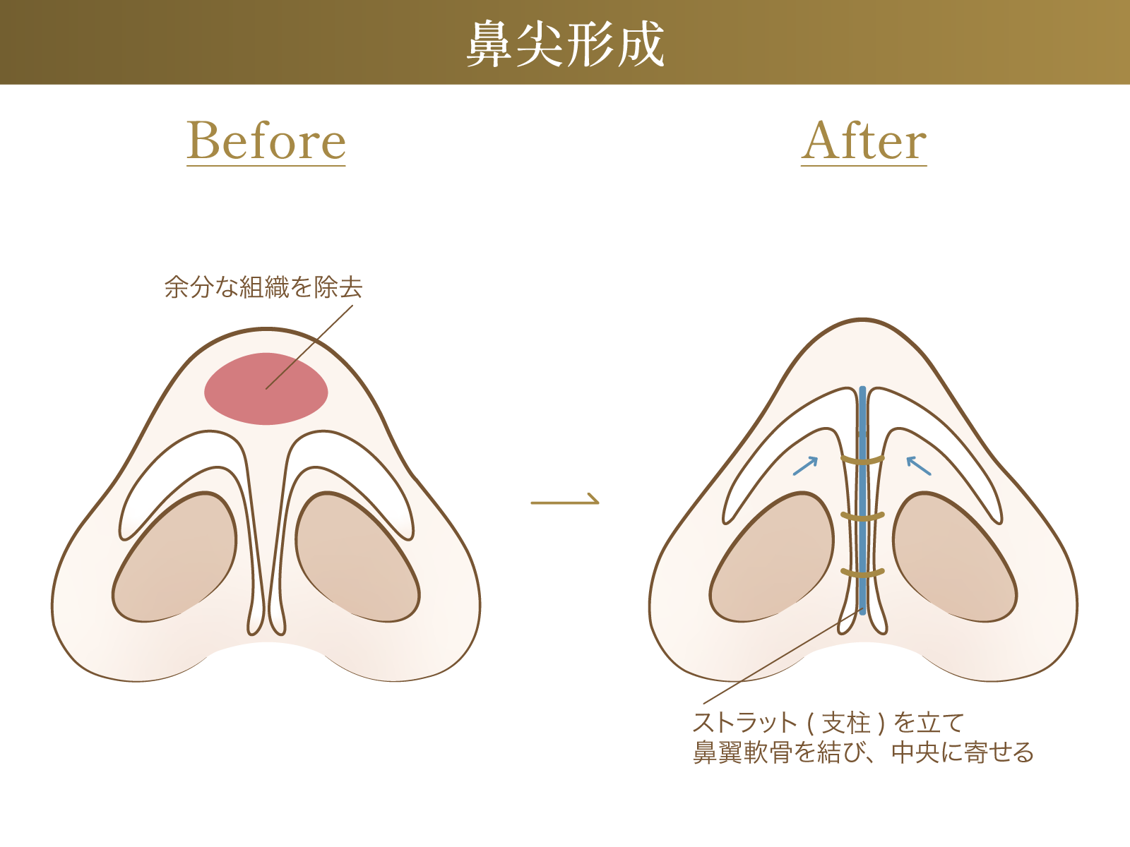 鼻尖形成についての図解画像