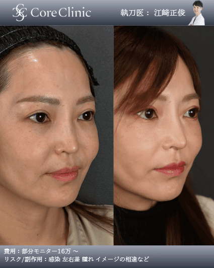 メーラーファット除去の術前後