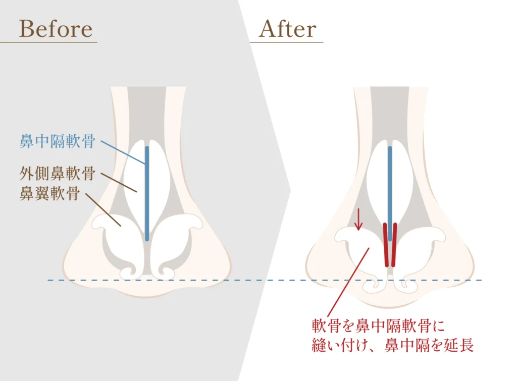 鼻中隔延長の正面の内部図解