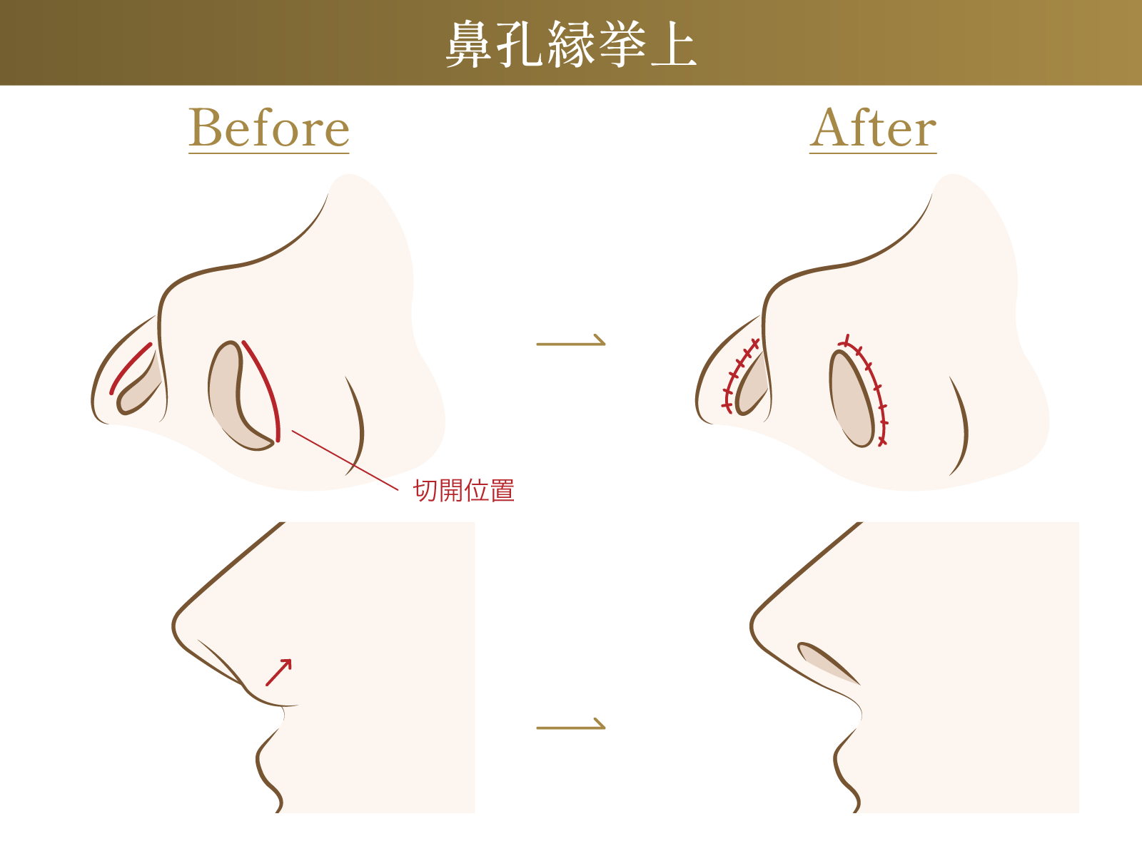 鼻孔縁挙上のビフォーアフター施術イメージ画像