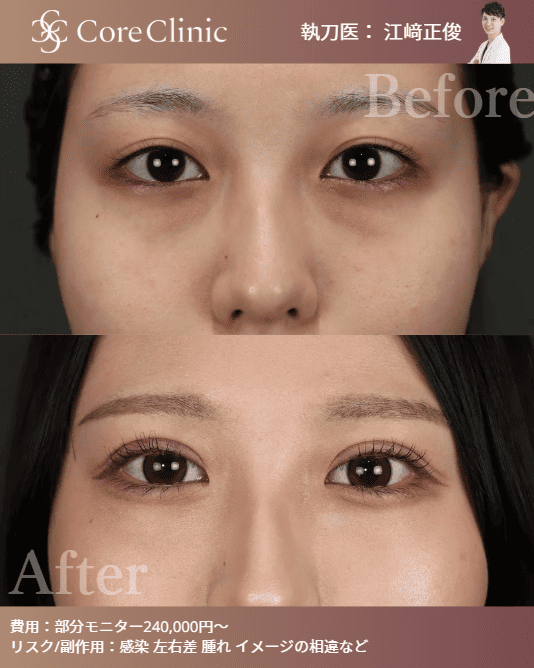 コアクリニック名古屋の「裏ハムラ法」によるクマ取りの症例写真