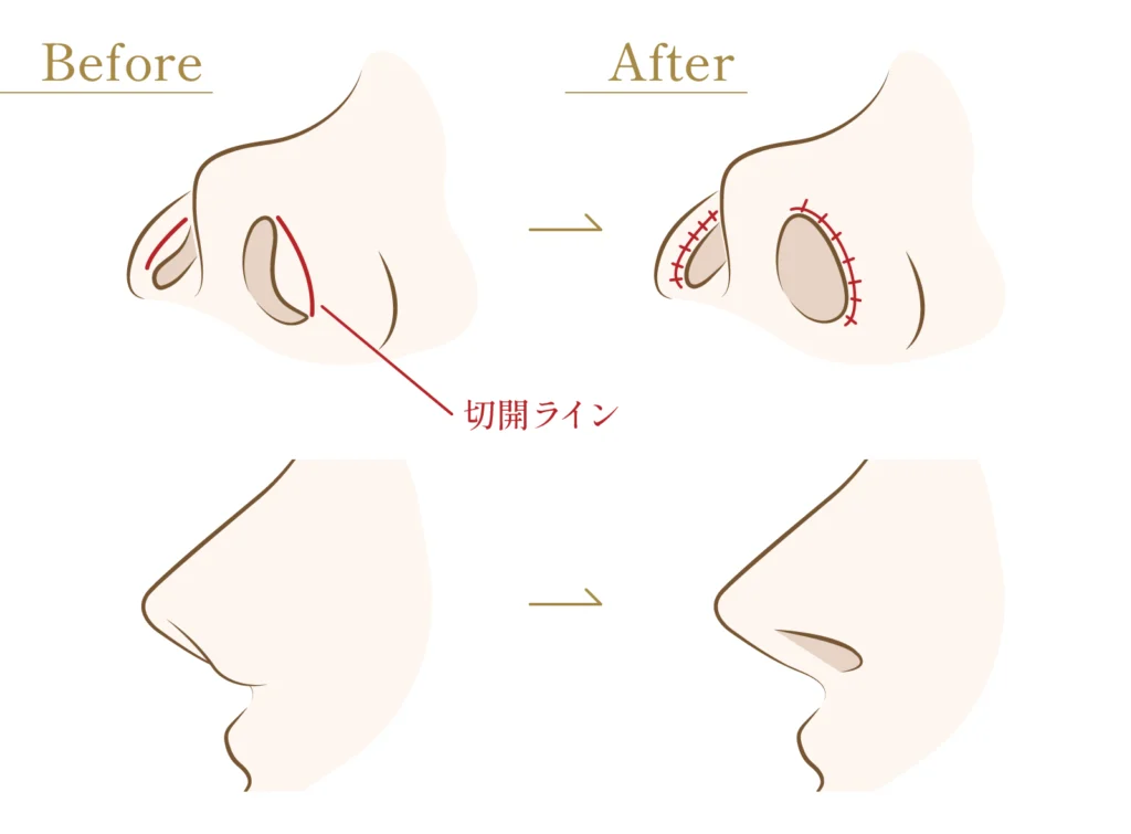 鼻孔縁挙上の施術方法