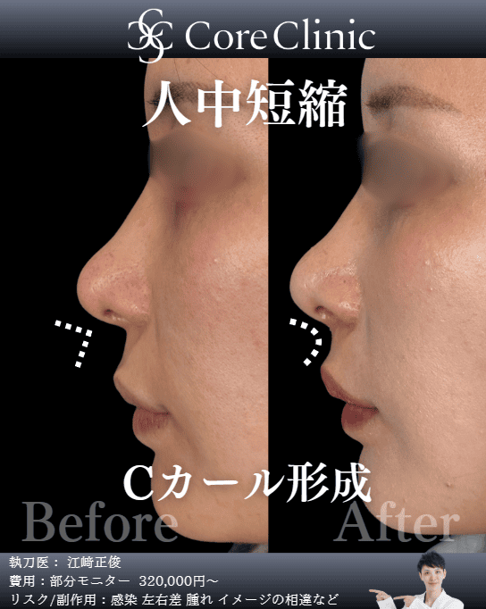 名古屋の猫手術（Cカール形成）の症例：横顔の術前後（Before/After）比較｜コアクリニック