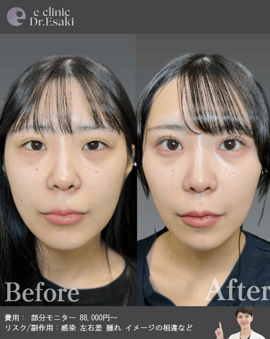 埋没法による二重整形の術前後(女性・正面)