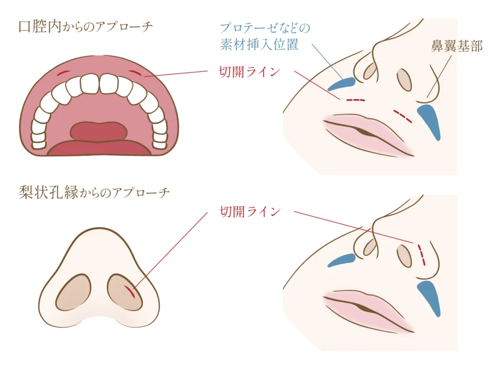 貴族手術の施術方法