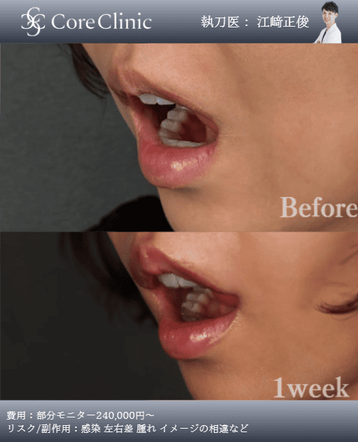 名古屋の口角挙上の症例：横の術前後（Before/After）比較｜コアクリニック