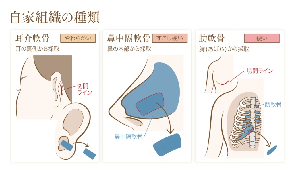 鼻中隔延長に使用する軟骨の種類についての解説