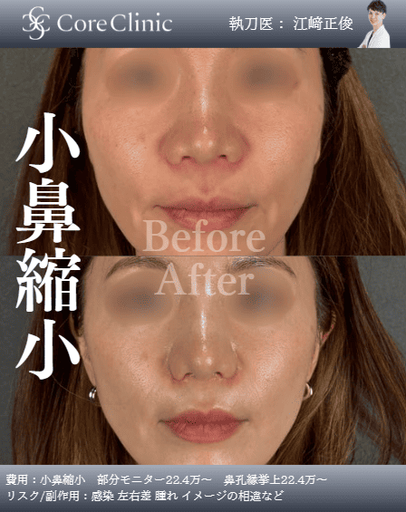 名古屋の小鼻縮小の症例：正面の術前後（Before/After）比較｜コアクリニック