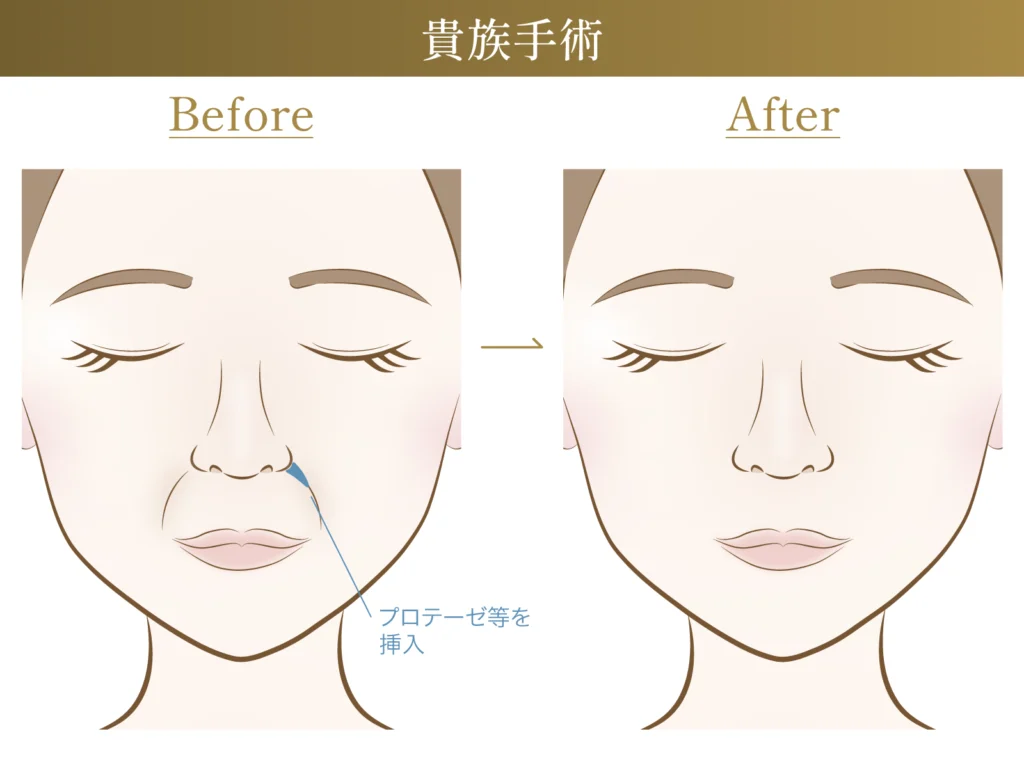 貴族手術の施術による変化についての図解画像