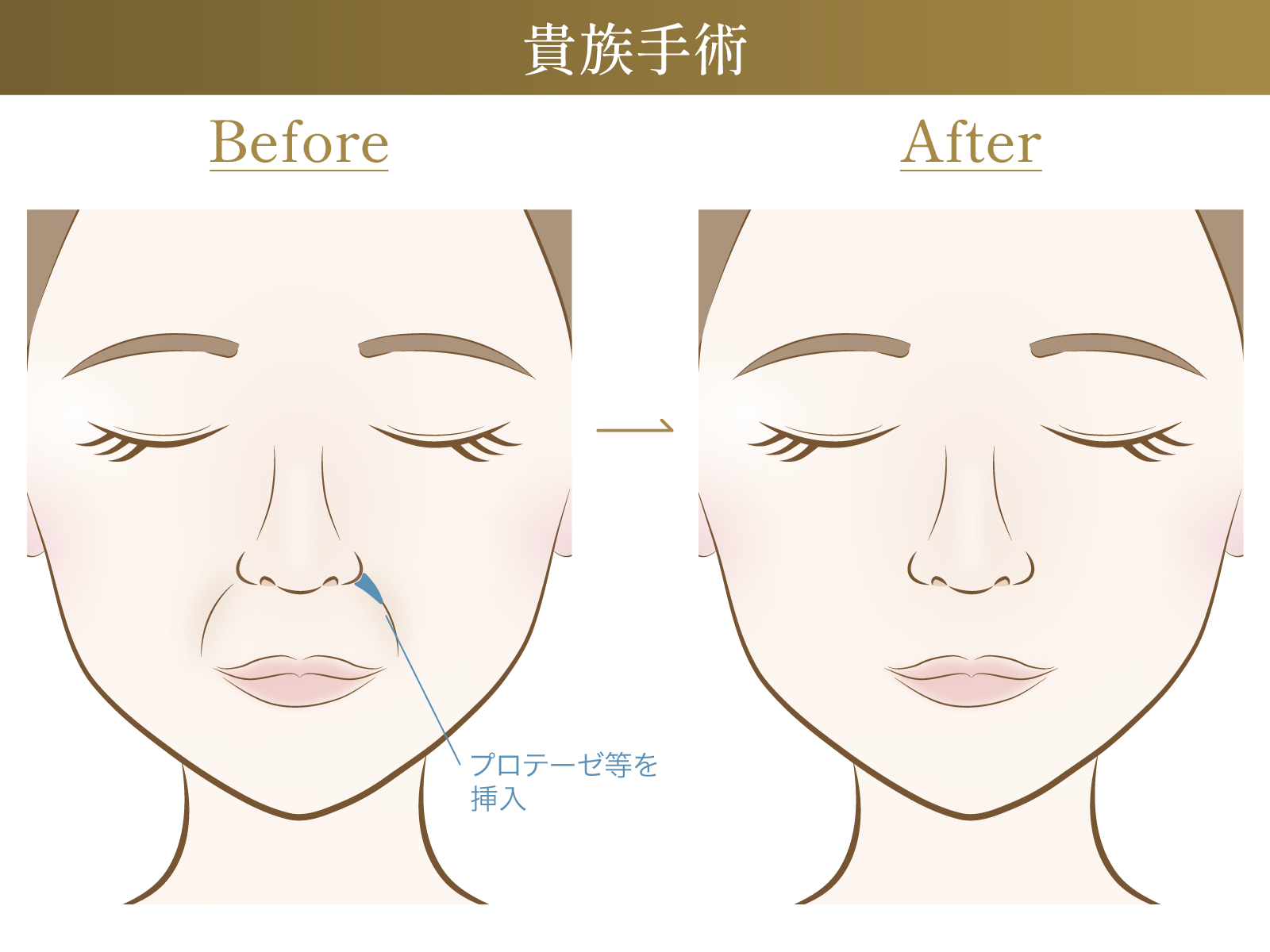 貴族手術の施術による変化についての図解画像