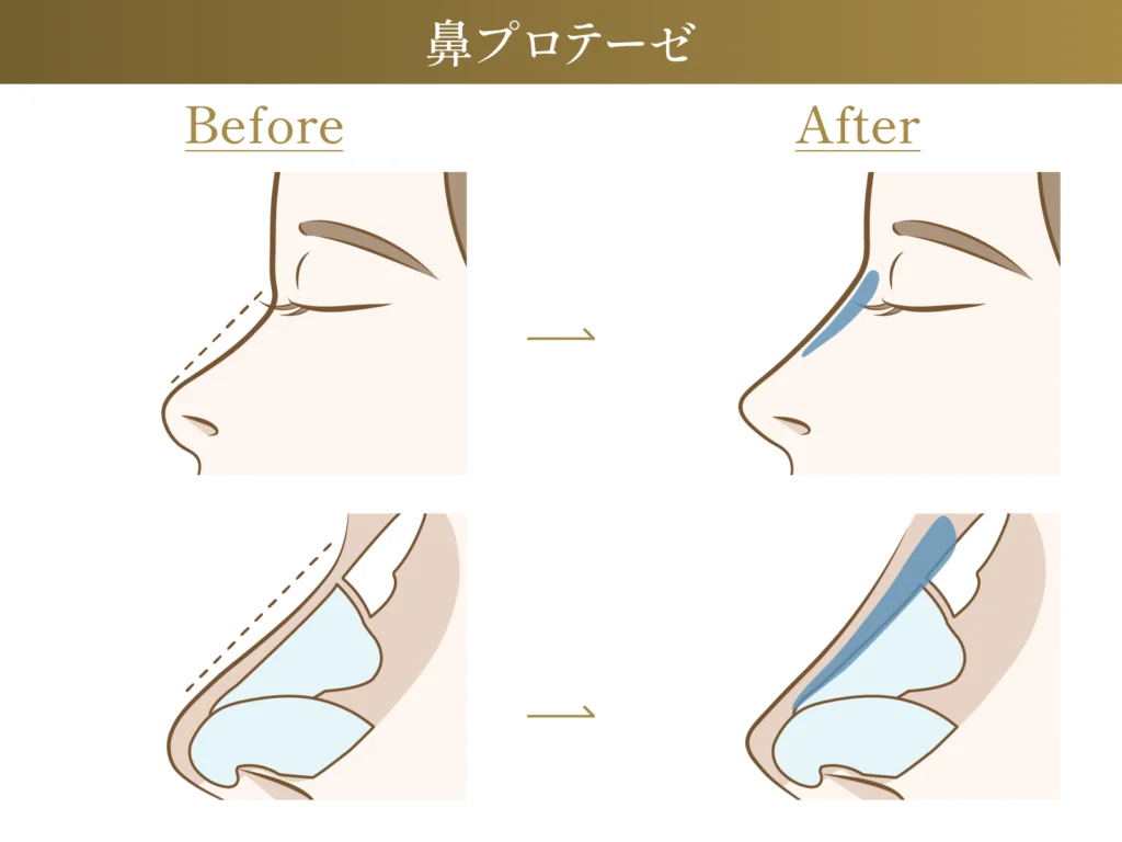 鼻プロテーゼのビフォーアフター施術イメージ画像