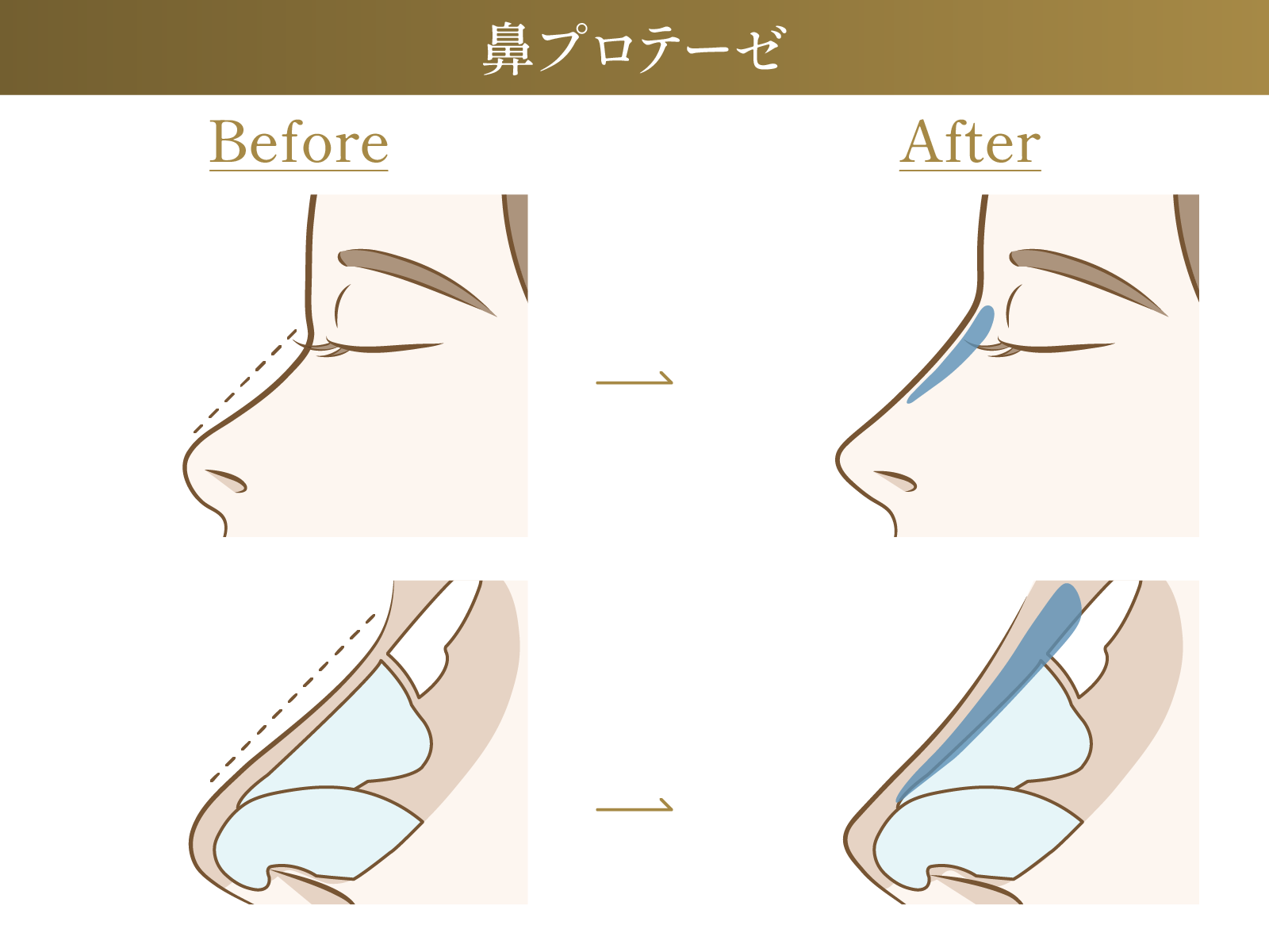鼻プロテーゼのビフォーアフター施術イメージ画像