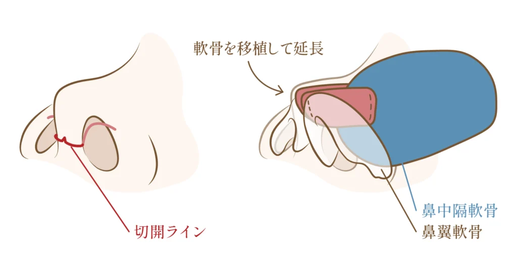 鼻中隔延長の施術方法