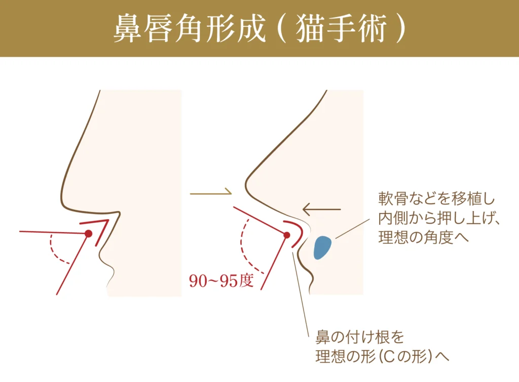鼻唇角形成(猫手術)の施術に関する図解画像
