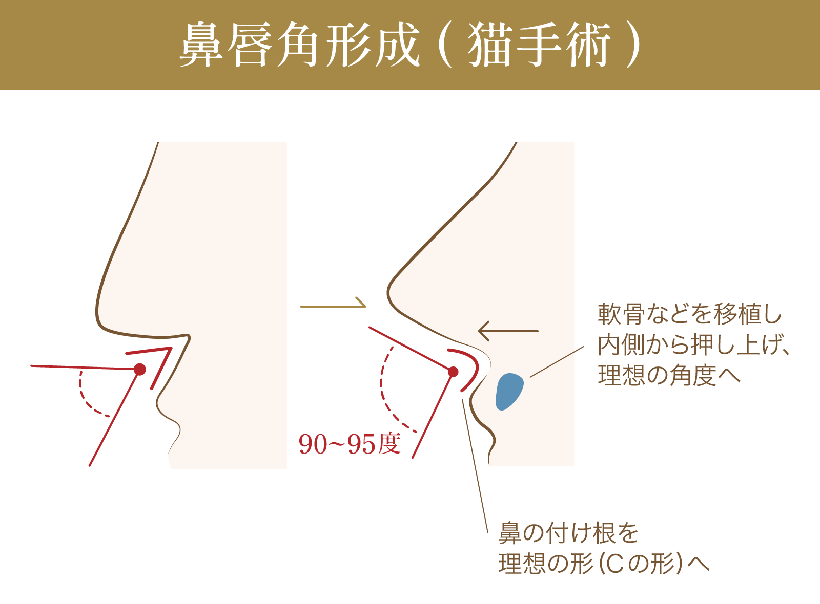 鼻唇角形成(猫手術)の施術に関する図解画像