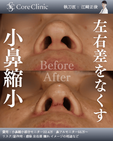 小鼻縮小の症例：下から見た術前後（Before/After）比較｜コアクリニック