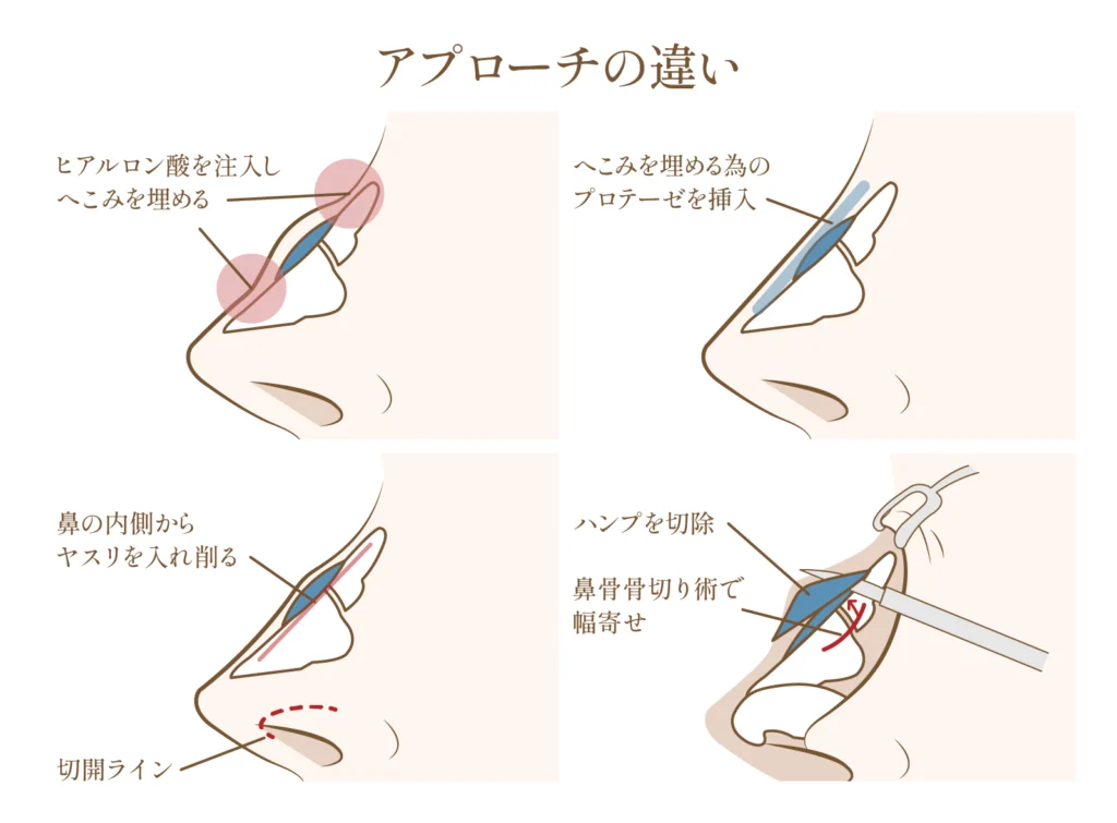鷲鼻修正の施術方法についての図解画像
