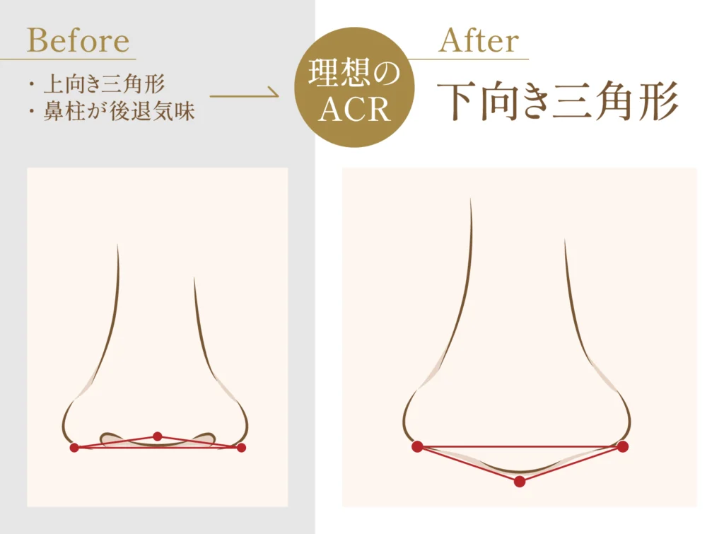 理想の鼻のACRについての図解画像