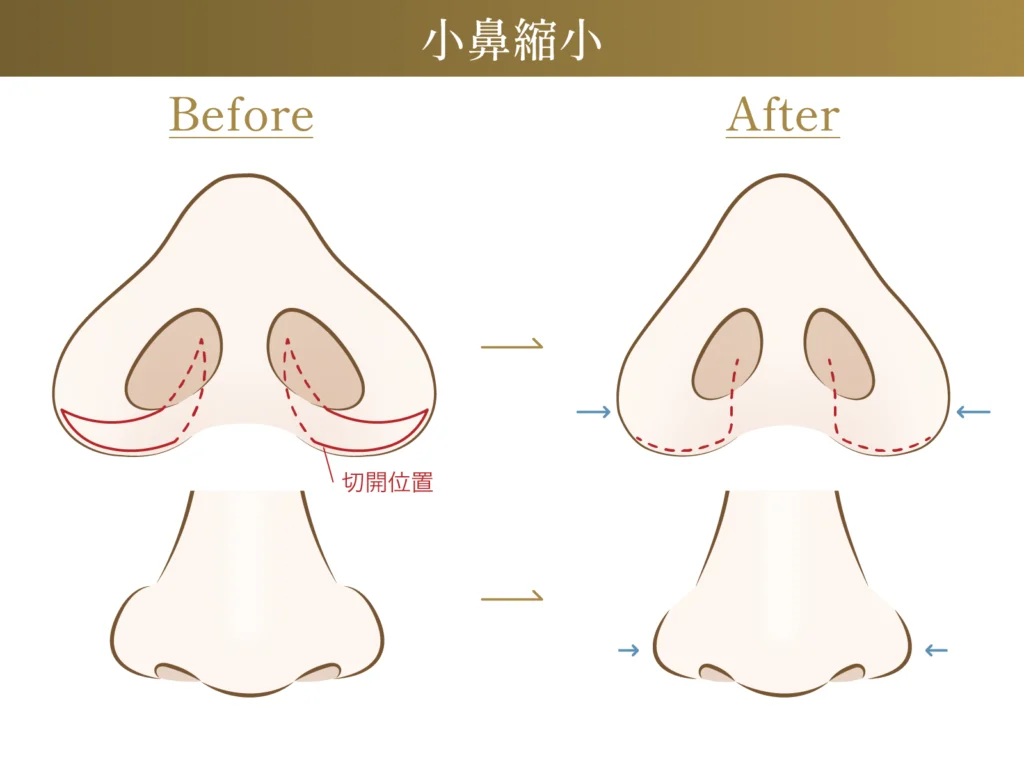 小鼻縮小の施術による変化についての図解画像