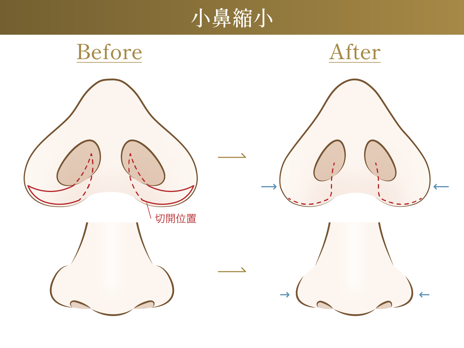 小鼻縮小の施術による変化についての図解画像