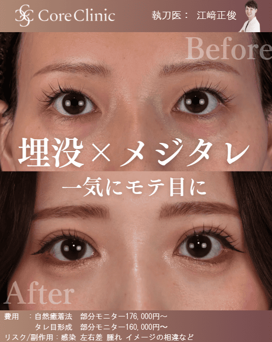 名古屋のタレ目形成（グラマラスライン）の症例：正面の術前後（Before/After）比較｜コアクリニック