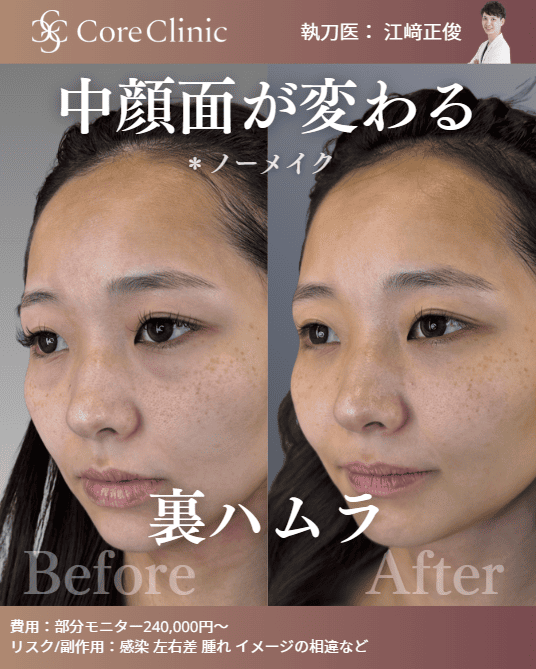 コアクリニック名古屋の「裏ハムラ法」によるクマ取りの症例写真