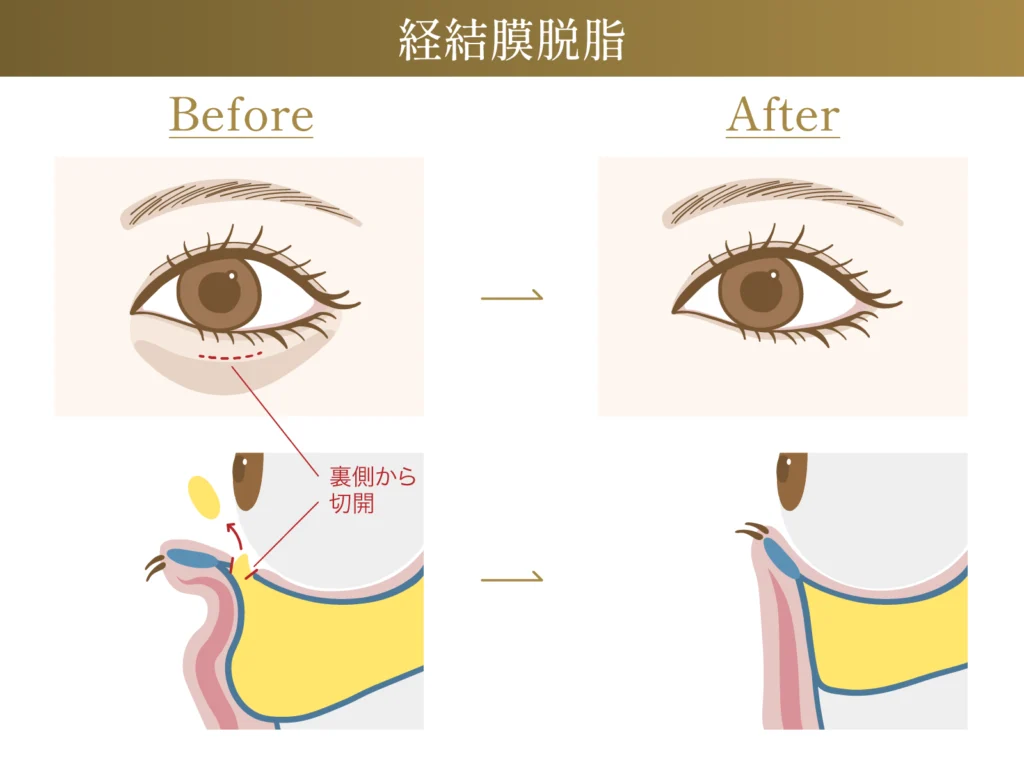 経結膜脱脂のビフォーアフター施術イメージ画像