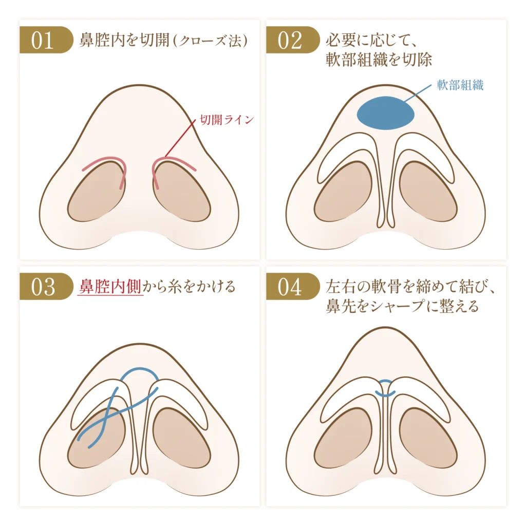 鼻尖形成クローズ法の施術方法についての図解画像