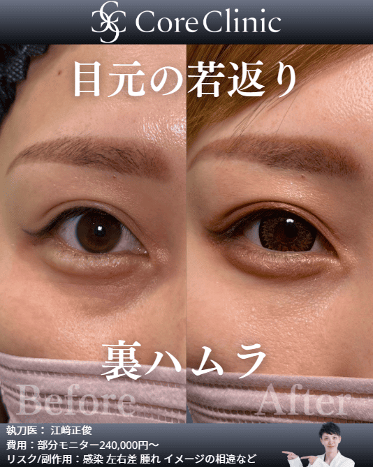 名古屋の裏ハムラによるクマ取りの症例：目元の術前後（Before/After）比較｜コアクリニック