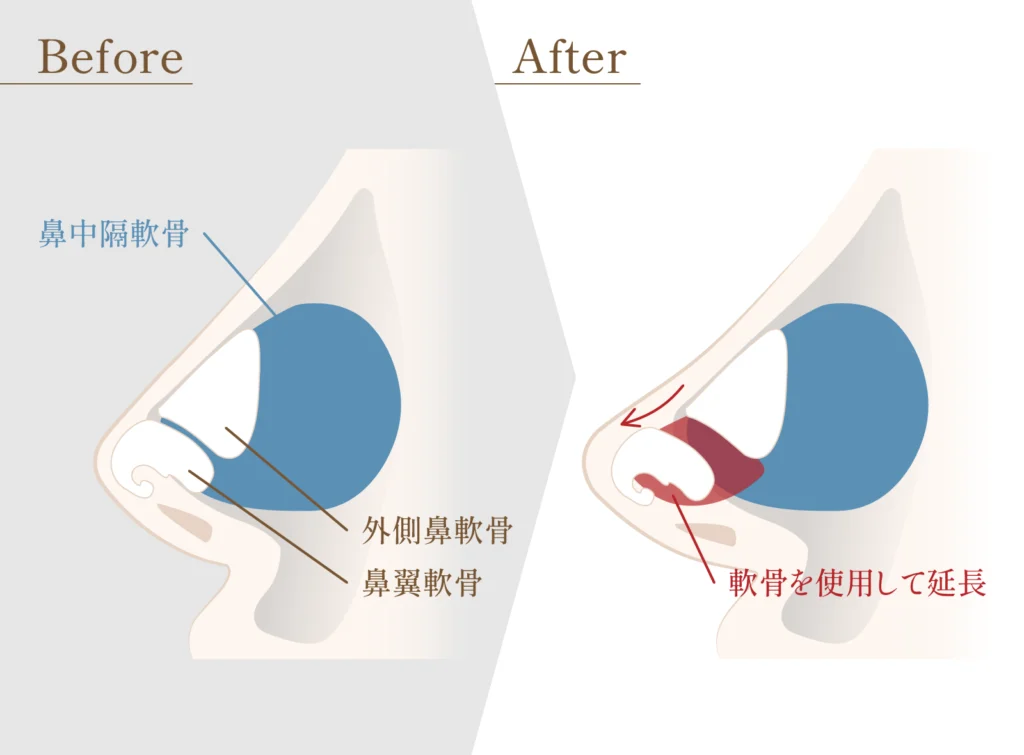 鼻中隔延長の横からの内部図解