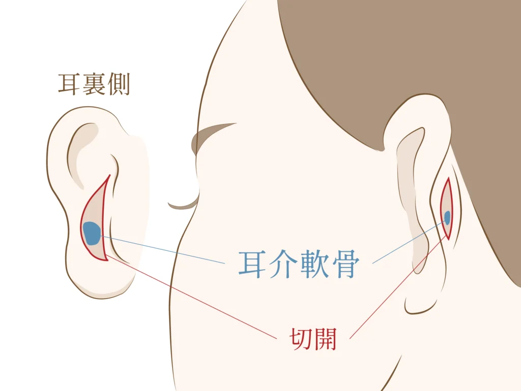 耳介軟骨移植に使う軟骨の採取方法