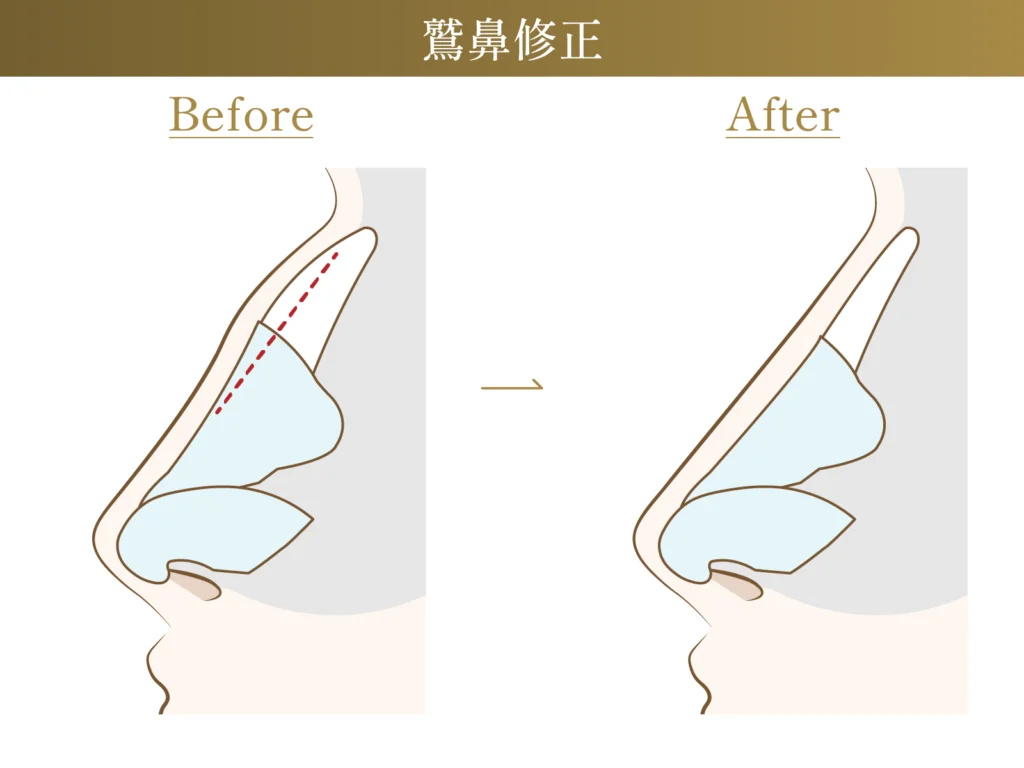 鷲鼻修正のビフォーアフターの施術イメージ画像