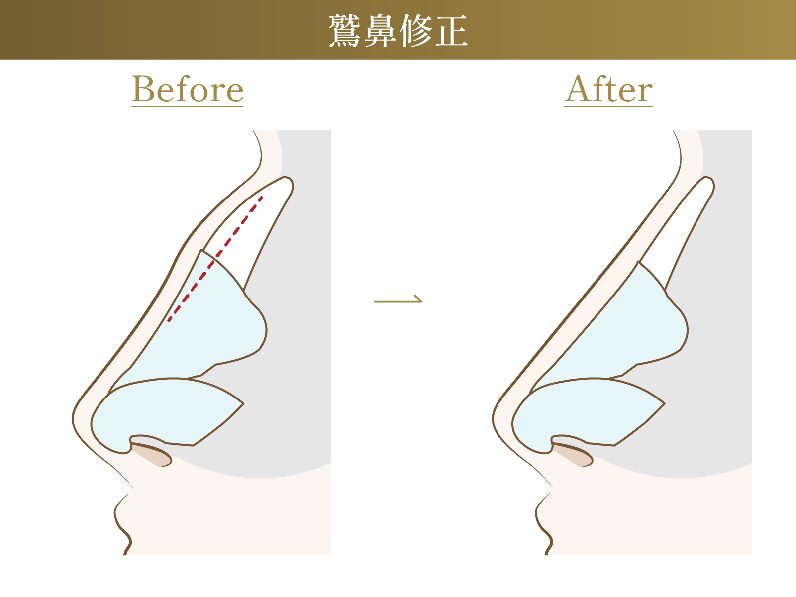 鷲鼻修正のビフォーアフターの施術イメージ画像
