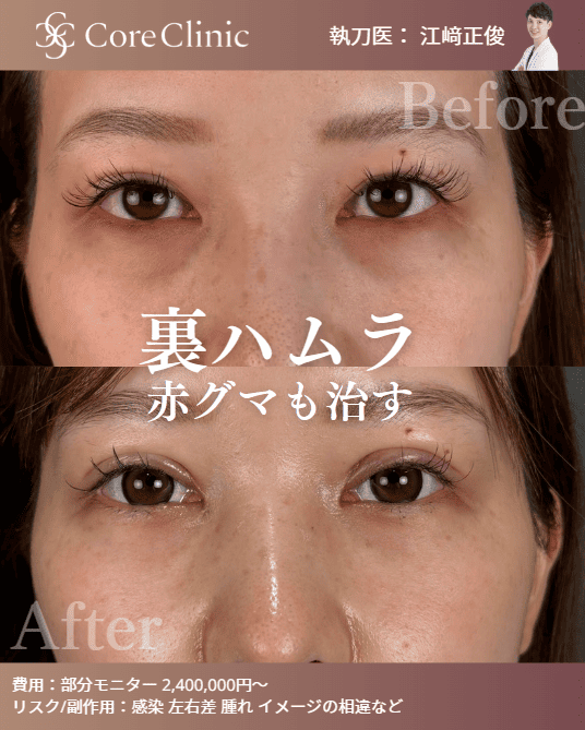 コアクリニック名古屋の「裏ハムラ法」によるクマ取りの症例写真