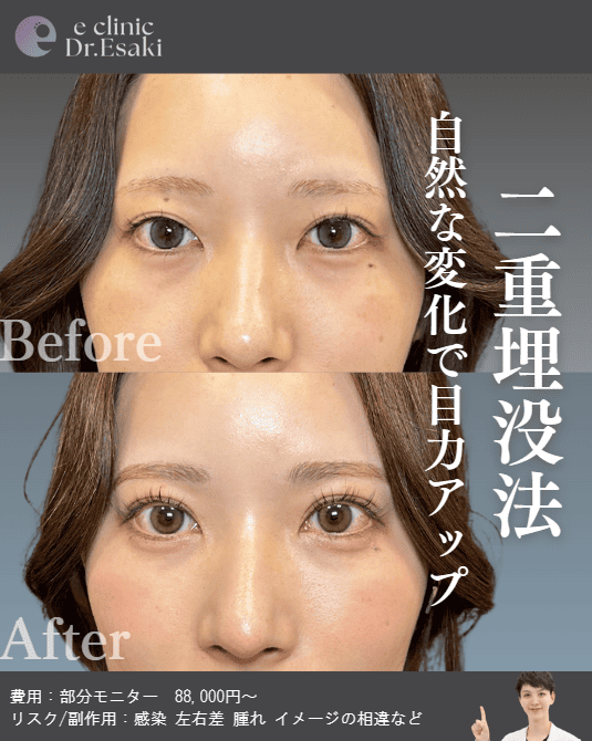 埋没法による二重整形の術前後(女性・正面)