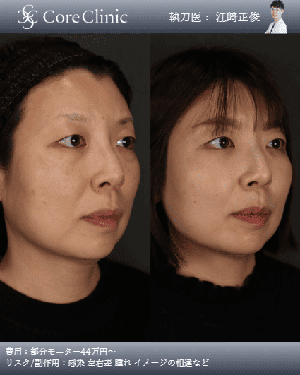 ミッドフェイスリフト術前後の症例写真