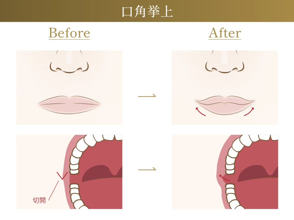 口角挙上のビフォーアフター施術イメージ画像