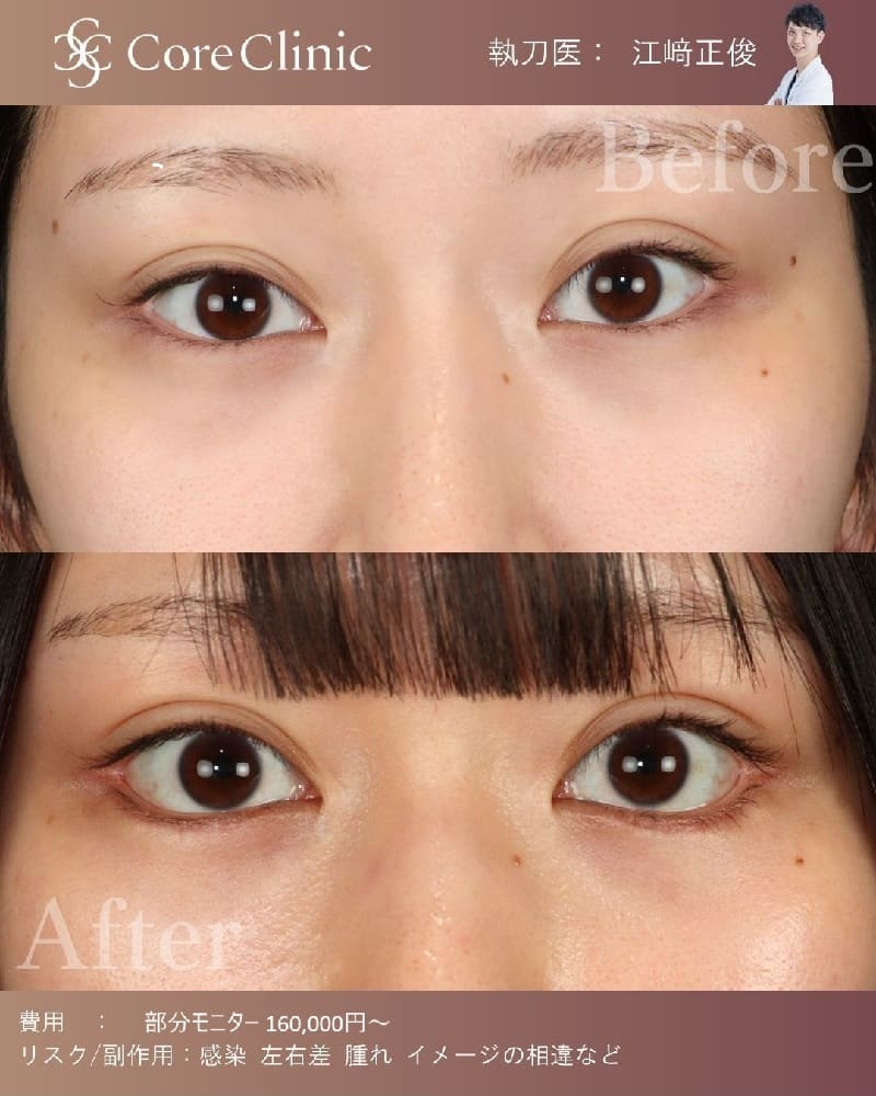 名古屋のタレ目形成（グラマラスライン）の症例：正面の術前後（Before/After）比較｜コアクリニック