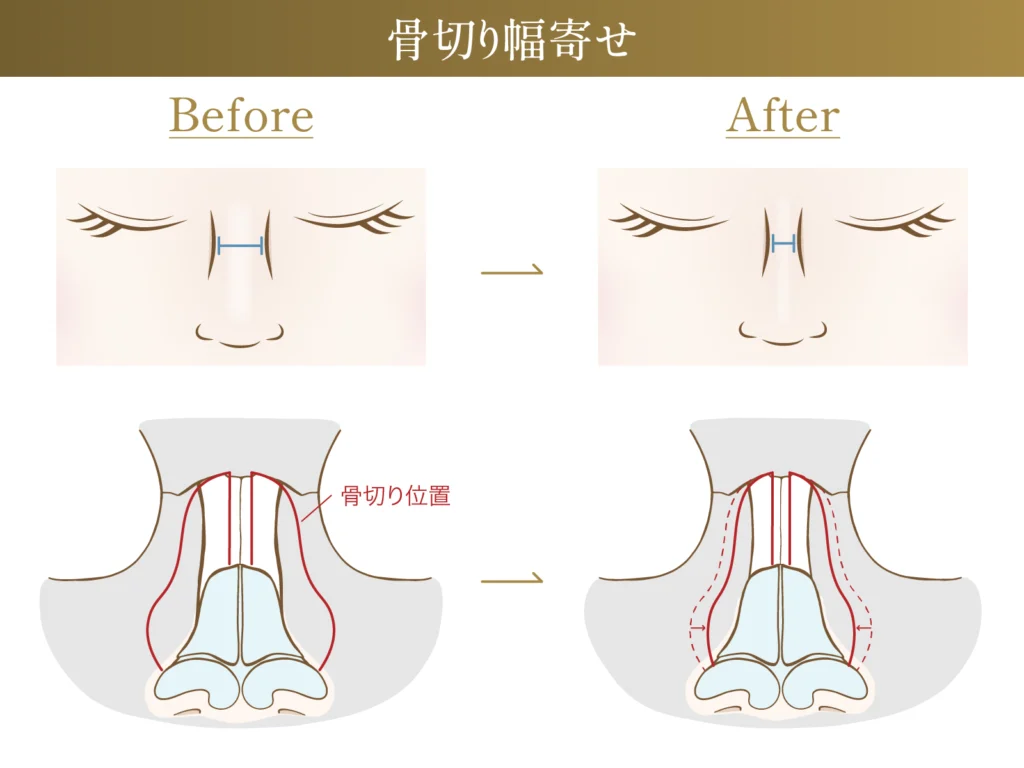 骨切り幅寄せのビフォーアフター施術イメージ画像
