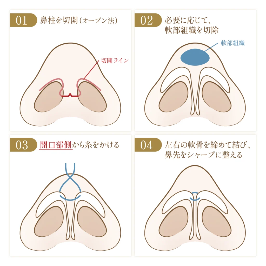 オープン法の鼻尖形成の施術方法