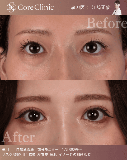 自然癒着法による二重整形の術前後(女性・正面)