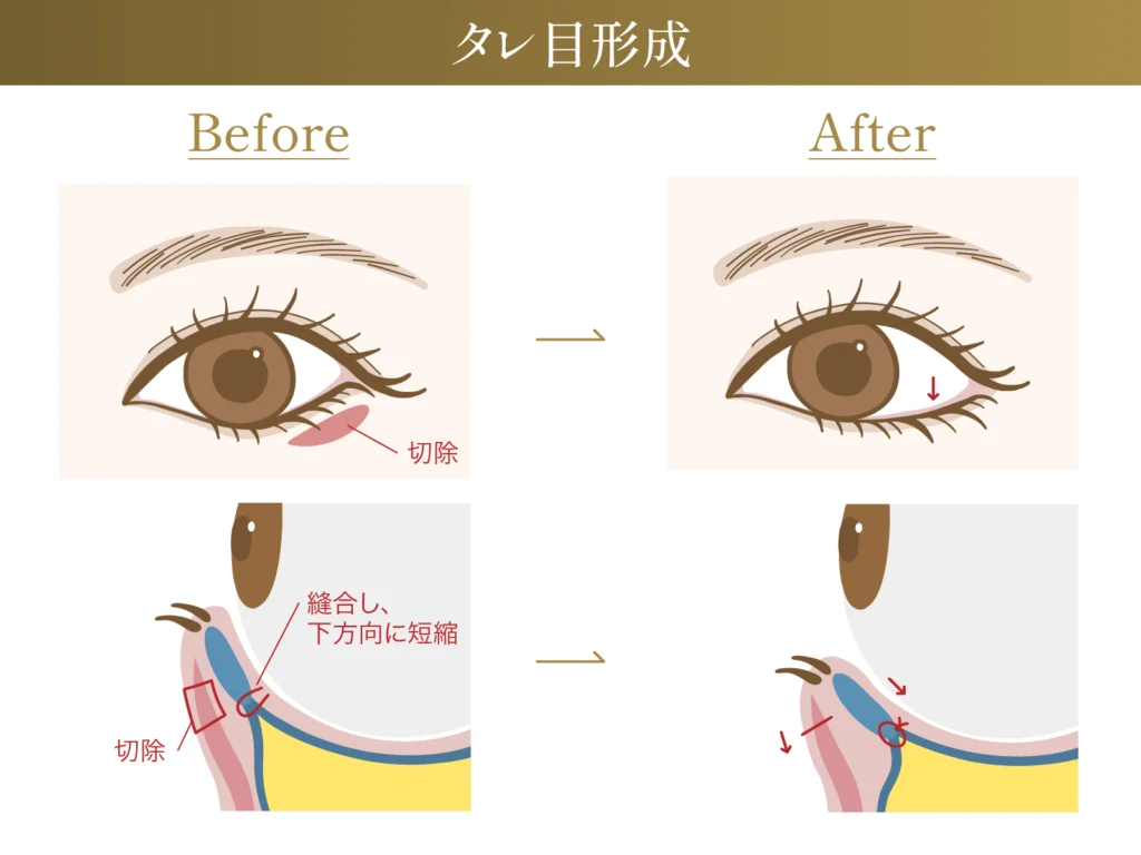 タレ目形成のビフォーアフター施術イメージ画像