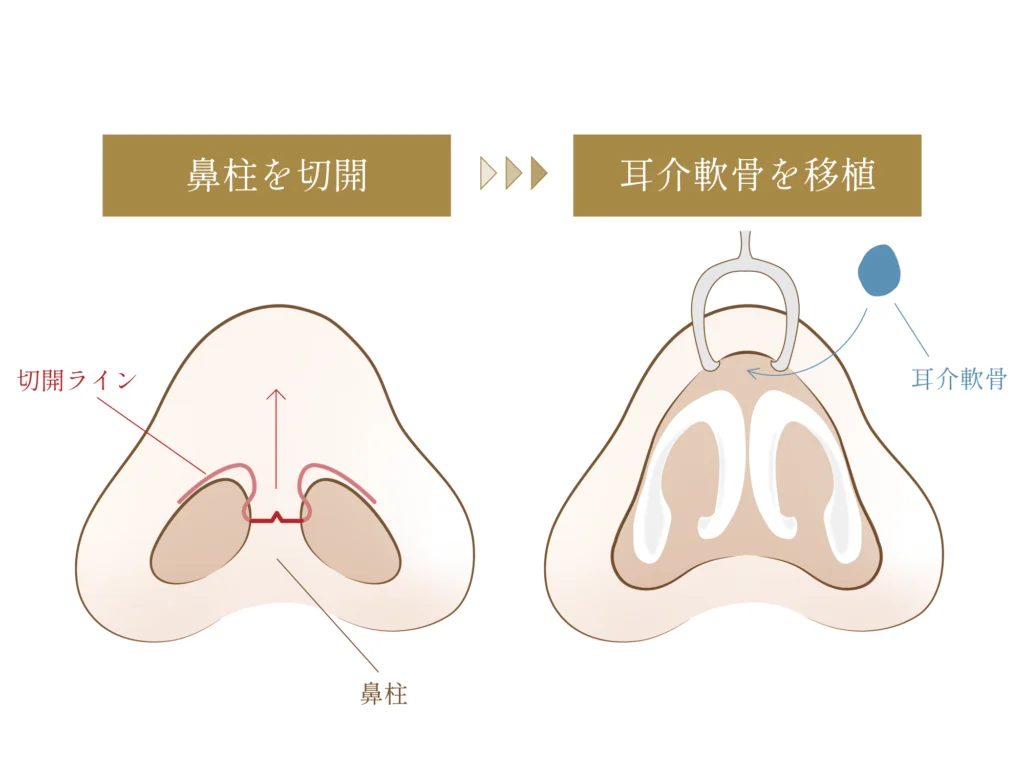 鼻尖軟骨移植を移植する図解画像