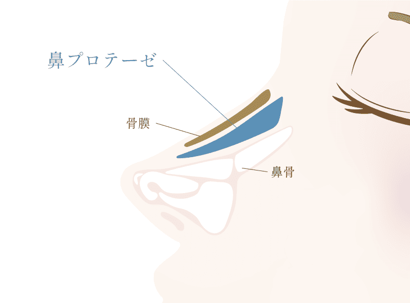 鼻プロテーゼの図解イラスト