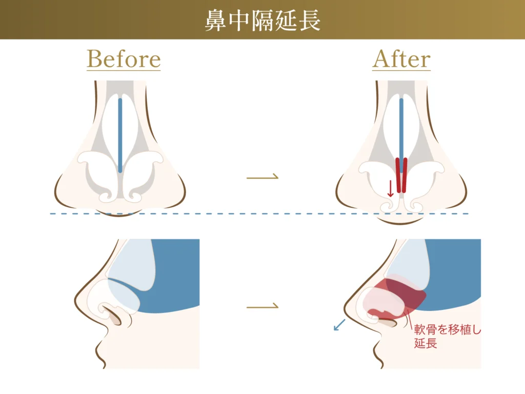 鼻中隔延長のビフォーアフター施術イメージ画像
