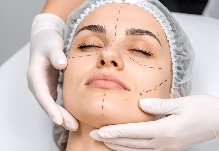 切開フェイスリフトとは